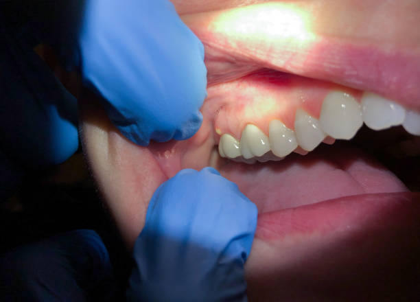 Best Emergency Wisdom Tooth Extraction in Clay Center, KS